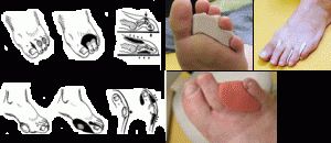 orthoplastie